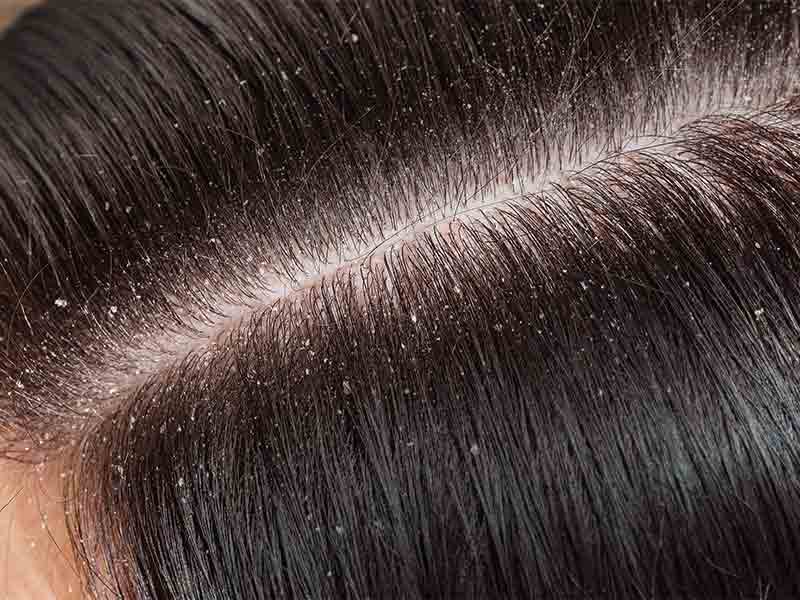 What Is Hair Dandruff Causes And Remedies Scarsdale Hair Salon Ny